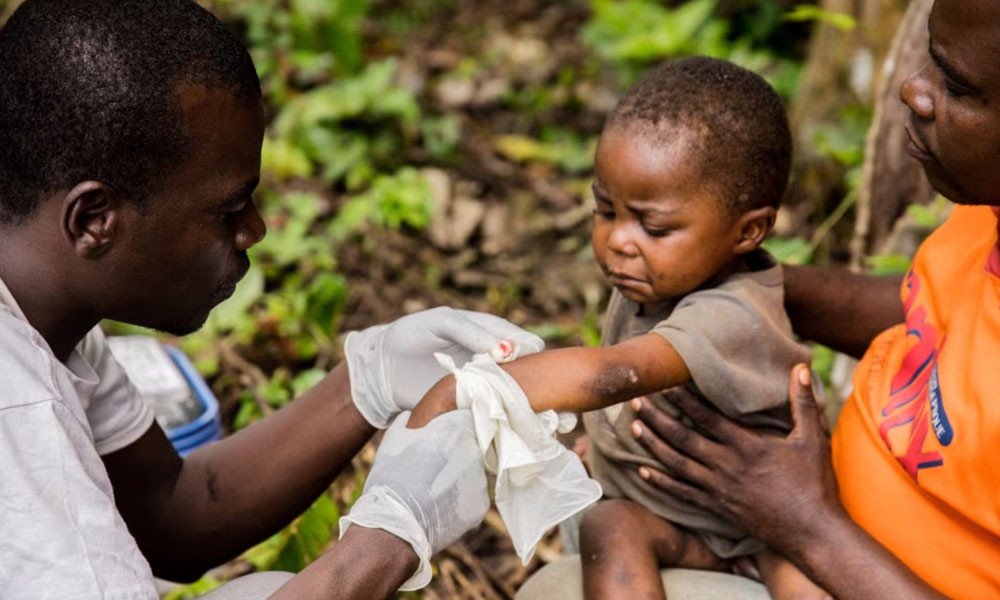 Deadly Monkeypox Outbreak Kills 548 in Congo